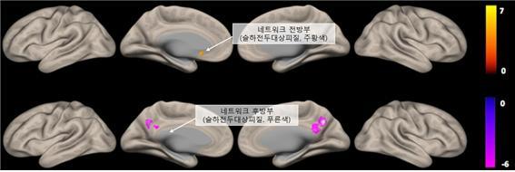 우울증·알츠하이머 연결고리 세계 최초 규명