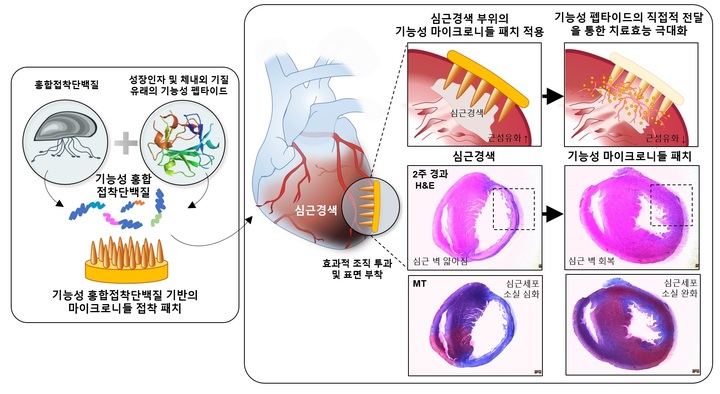 ‘심근경색 치료용 기능성 마이크로니들 접착 패치’ 모식도 *재판매 및 DB 금지