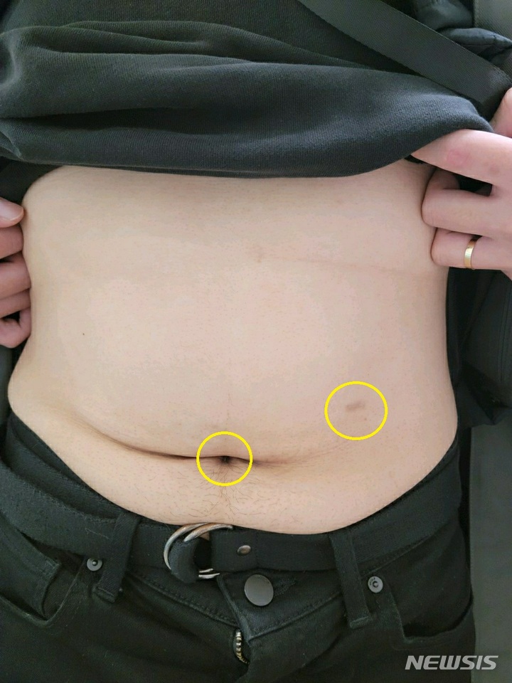 [서울=뉴시스]분당서울대병원 비만대사센터 외과 박영석 교수팀은 1~2개의 절개창만으로 수술하는 ‘축소포트 위소매절제술’이 4~5개의 절개창을 내는 기존 복강경 비만대사수술과 비교해 안전성이나 수술 효과 측면에서 동등하거나 우수한 수준인 것으로 나타났다고 11일 밝혔다. (사진= 분당서울대병원 제공) 2022.01.11