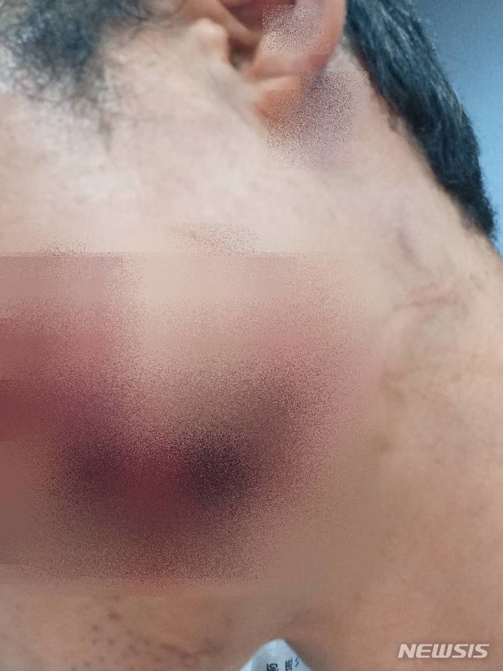 [전주=뉴시스]윤난슬 기자 = 50대 남성 2명이 지인에게 폭행을 당해 크게 다치는 사건이 발생한 가운데 신고를 받고 출동한 경찰은 제대로 된 조사 없이 사건을 종결시킨 것으로 드러나 논란이 일고 있다. 사진은 피해자 모습.(사진=피해자 가족 측 제공) 