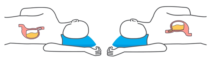 위식도 역류질환이 있는 경우 왼쪽으로 돌아눕는 자세(왼쪽)로 잠을 자면 위산 역류를 방지할 수 있다.(사진 : 서울아산병원 제공) *재판매 및 DB 금지