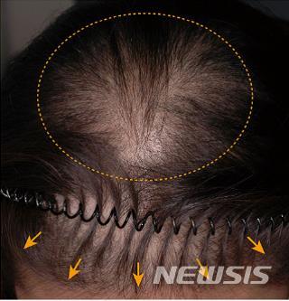 [서울=뉴시스]국내 의료진이 특정 유전자에 단일 염기다형성(SNP) 변이가 있는 20~30대 여성은 탈모 발생 가능성이 더 높다는 사실을 발견했다. (사진= 서울대병원 제공) 2022.03.23