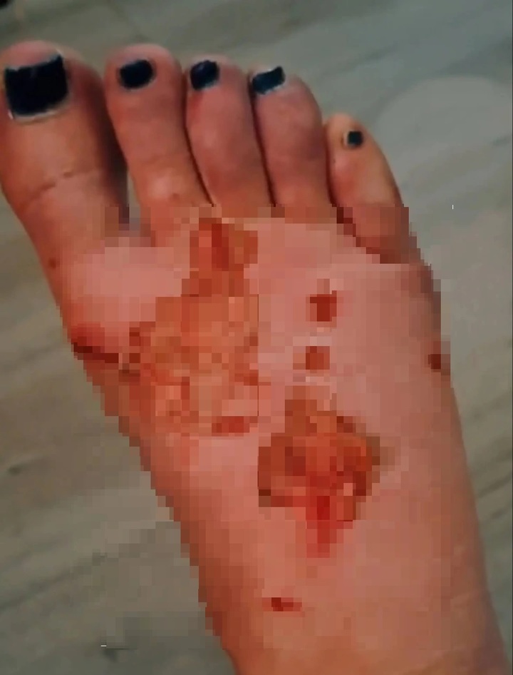[서울=뉴시스] 영국 리버풀에서 셀프 페디큐어를 하던 중 발등에 손톱 접착제를 떨어뜨려 3도 화상을 입은 몰리 펄롱(25)의 발 모습. (출처 : 틱톡 영상 캡처) 2022.03.25. *재판매 및 DB 금지