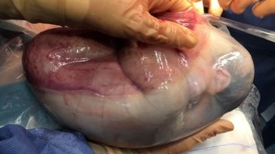 [서울=뉴시스] 지난 23일 스페인 발렌시아 동부 카스텔론 주 비나로스 시의 한 병원에서 양막이 찢어지지 않은 채 태어난 아이의 모습. (출처 : 트위터 갈무리) 2022.03.28. *재판매 및 DB 금지