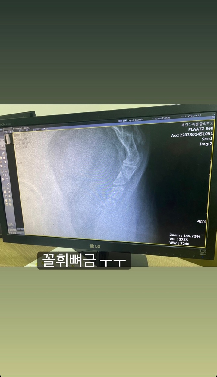 [서울=뉴시스] 배우 황보라 엑스레이 사진. 2022.03.30.(사진=인스타그램 스토리 캡처 제공) photo@newsis.com*재판매 및 DB 금지 *재판매 및 DB 금지