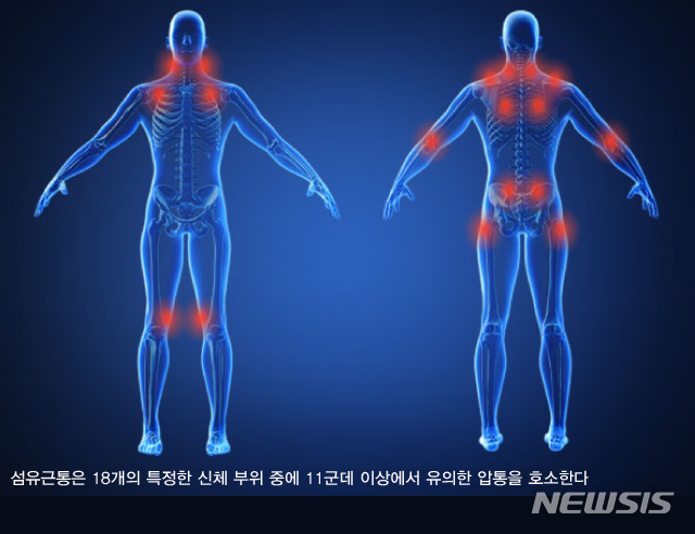 [서울=뉴시스]미국 류마티스학회에서 제시하는 18곳의 특징적인 압통점 분포. 18곳의 압통점(앞쪽 6개·뒷쪽 12개) 중 11곳 이상에서 통증이 나타나면 섬유근통으로 진단한다. (그래픽= 안지혜 기자) 2022.04.01 