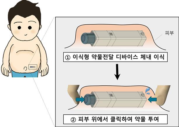서울대병원 의공학과 최영빈, 내분비대사내과 조영민 교수팀은 피부 위에서 손쉽게 버튼 클릭으로 정교한 양의 약물을 체내에 주입할 수 있는 '이식형 약물전달 디바이스'를 개발했다고 6일 밝혔다.(사진 : 서울대병원 제공) *재판매 및 DB 금지