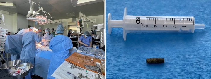 [서울=뉴시스] 우크라이나 수도 키이우에서 의료진이 심장에 총을 맞은 병사의 수술을 집도하고 있다(왼쪽). 오른쪽은 병사의 심장에서 꺼낸 총알의 모습. (출처 : 한나 리우바코바 트위터) 2022.04.13. *재판매 및 DB 금지