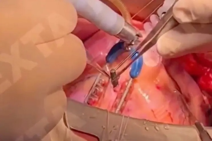 [서울=뉴시스] 우크라이나 수도 키이우에서 의료진이 부상병의 심장에서 총알을 꺼내고 있다. (출처 : 넥스타TV 트위터 영상 캡처) 2022.04.13. *재판매 및 DB 금지