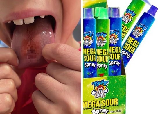 [서울=뉴시스] 호주 퍼스에 거주하는 소년이 사탕을 먹고 혀에 화상을 입은 모습. 소년의 사진과 함께 공유된 사탕 (사진=CPR 키즈 페이스북 갈무리) 2022.04.28. *재판매 및 DB 금지