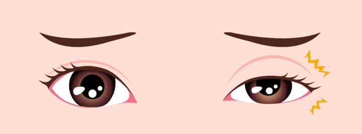 흔히 눈 떨림 증상이 나타나면 마그네슘 부족 때문이라고 생각하지만, 증상이 오래 지속되면 뇌 신경 질환이 아닌지 의심해봐야한다.(사진 : 나누리병원 제공) *재판매 및 DB 금지