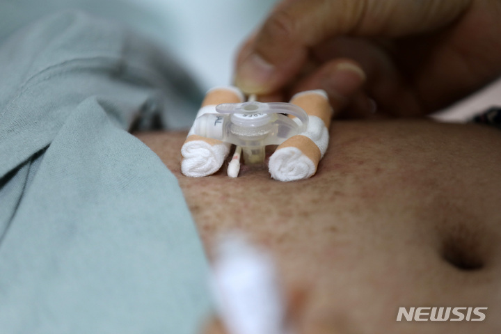 [대구=뉴시스] 백동현 기자 = 지난 4월 28일 가영이(가명·여) 어머니가 집에서 외출 전 위루관 수술 부위를 소독하고 있다. 2022.05.05. livertrent@newsis.com