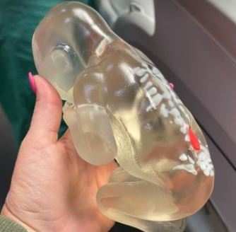 [서울=뉴시스] 지난 11일(현지시간) 미국 올랜도 위니 팔머 병원에서 임신 중 태아 척추 갈림증 치료 수술을 받은 여성 자이든 애슐리아가 태아 모형을 들고 있는 모습. (사진=자이든 애슐리아 인스타그램 갈무리) 2022.05.19. *재판매 및 DB 금지