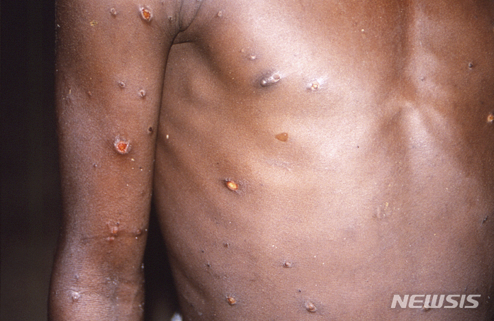 This 1997 image provided by CDC, shows the right arm and torso of a patient, whose skin displayed a number of lesions due to what had been an active case of monkeypox.&nbsp; As more cases of monkeypox are detected in Europe and North America in 2022, some scientists who have monitored numerous outbreaks in Africa say they are baffled by the unusual disease's spread in developed countries.&nbsp; (CDC via AP)