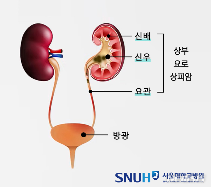 [서울=뉴시스]요로상피암은 소변이 흐르는 요로의 상피세포에 생긴 암이다. 이 중 요로 상부(신배, 신우, 요관)에 암이 생기면 ‘상부요로상피암’이라 부른다. (사진= 서울대병원 제공)