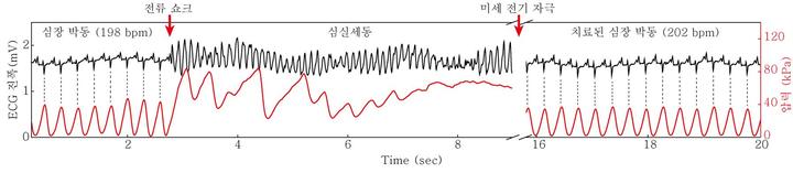 [대전=뉴시스] 실시간 심실 세동 부정맥 진단 및 치료 데이터. 빨간색 선이 전자패치를 이용해 심실 세동을 진단하고 치료 기능을 수행한 결과다. *재판매 및 DB 금지