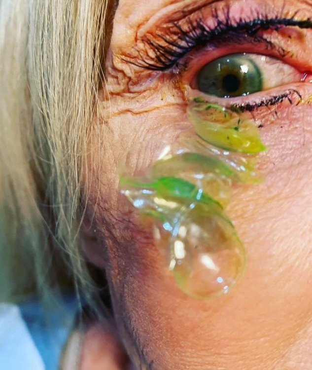 [서울=뉴시스] 캘리포니아의 한 안과의가 환자의 눈에서 렌즈 23개를 빼냈다고 비즈니스인사이더가 13일(현지시간) 보도했다. (사진출처: 인스타그램 캡처) 2022.10.14. *재판매 및 DB 금지