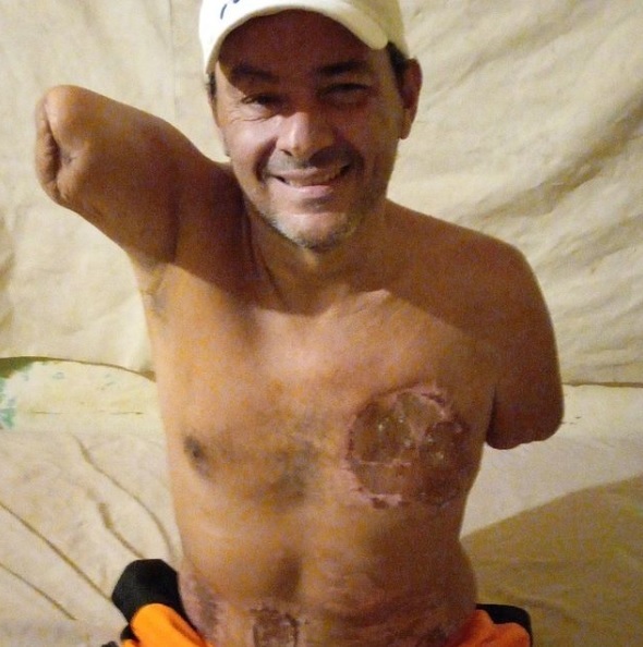 [서울=뉴시스] 베네수엘라에 거주 중인 엘비스 사나브리아(48)는 부족한 물을 충당·비축하기 위한 우물을 파다 감전 사고를 당해 사지를 절단해야 했다 (사진출처: 엘비스 인스타그램 캡처) 2022.12.26. *재판매 및 DB 금지