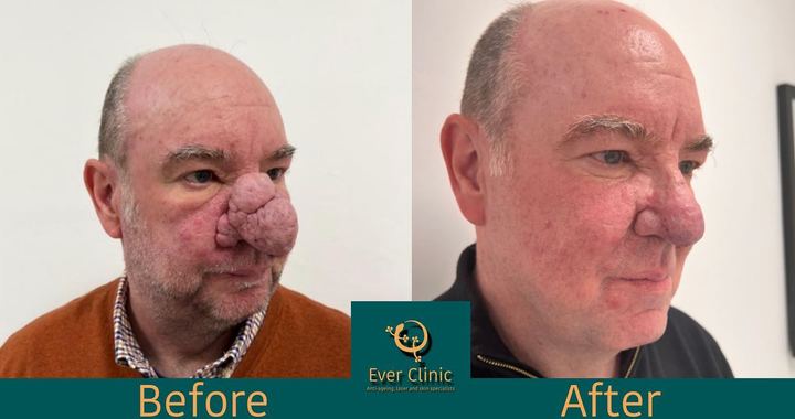 [서울=뉴시스] 심각한 딸기코를 앓고 있던 앨런 핀들레이(56)의 수술 전·후 모습, 앨런은 외모 콤플렉스로 인해 몇 년간 사회관계를 단절했다 (사진출처: 에버클리닉 페이스북 캡처) 2022.12.26. *재판매 및 DB 금지