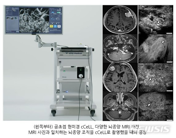 [서울=뉴시스]고려대학교 안암병원 신경외과 강신혁 교수 연구팀과 국내 스타트업 브이픽스메디칼은 최근 개발한 씨쎌로 수술 중 정상조직과 종양조직의 구분뿐 아니라 다양한 뇌종양 세포 및 조직들의 형태까지 실시간 정확히 진단할 수 있다는 것을 확인했다. (사진= 고려대 안암병원 제공) 2023.02.02. photo@newsis.com