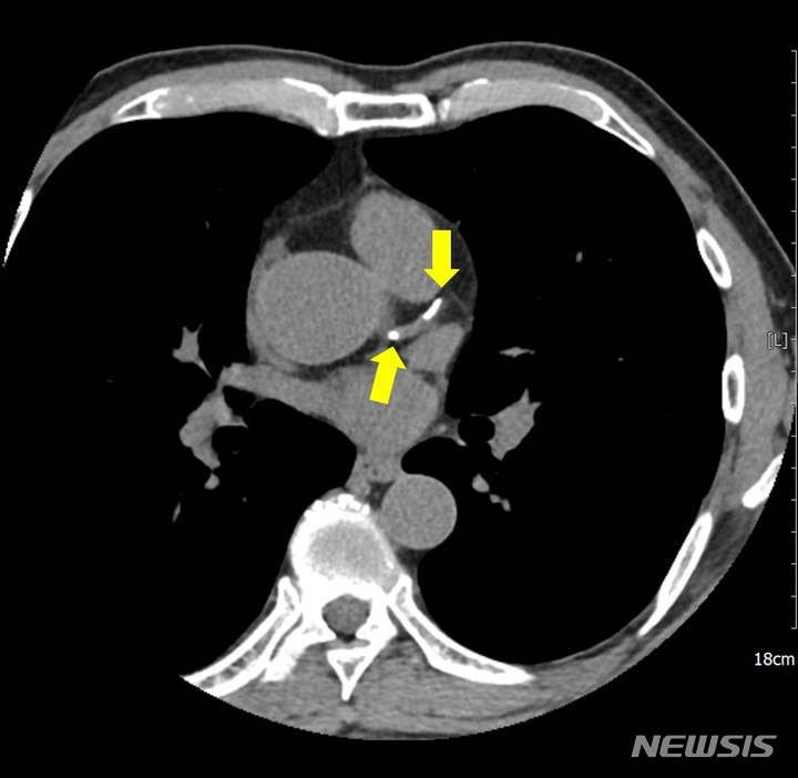 [서울=뉴시스]관상동맥 석회화란 심장에 산소와 영양분을 공급해주는 혈관인 관상동맥에 동맥경화증으로 칼슘이 쌓여 혈관이 딱딱하게 굳어지는 현상을 말한다. (이미지= 강북삼성병원 제공) 2023.03.08. photo@newsis.com.
