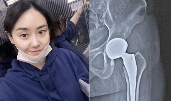 [서울=뉴시스] 간 이식 수술을 받았던 배우 윤주(왼쪽)가 인공관절 수술을 앞두고 있다고 밝혔다. 2023.06.08. (사진=윤주 인스타그램 캡처) photo@newsis.com&nbsp; *재판매 및 DB 금지