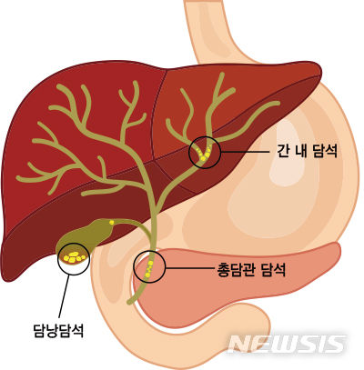 [서울=뉴시스]담석의 부위별 명칭과 위치. (이미지= 강동경희대병원 제공) 2023.09.14. photo@newsis.com. 