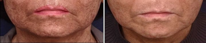 [수원=뉴시스] 치료 전(왼쪽), 치료 후 모습. (사진=아주대병원 제공) 2023.10.26. photo@newsis.com *재판매 및 DB 금지