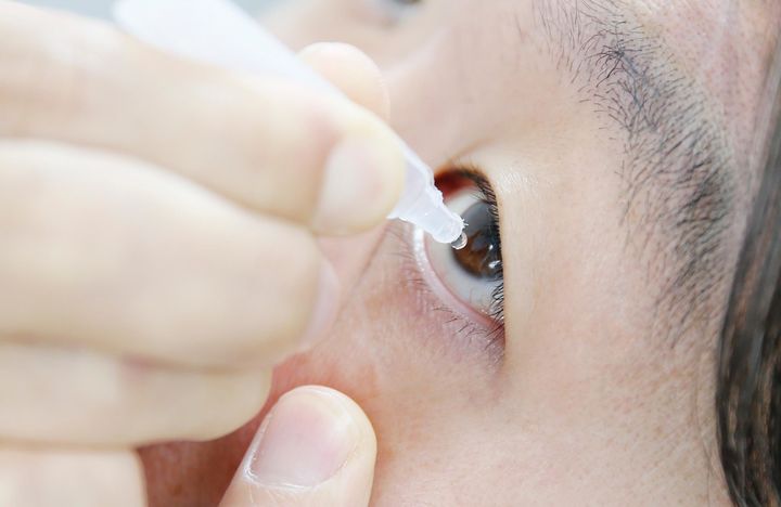 [서울=뉴시스] 14일 의료계에 따르면 결막염, 안구건조증 등 안구 표면의 만성적인 염증이 있을 때 결막 상피세포와 단백질 분비물이 변성되면서 결막결석이 생기게 된다. (사진=고려대 안암병원 제공) 202312.13. photo@newsis.com *재판매 및 DB 금지