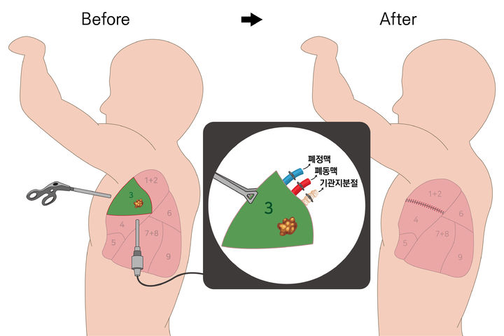 인도시아닌그린(ICG) 폐구역 절제술 모식도 (그림=동남권원자력의학원 제공) *재판매 및 DB 금지