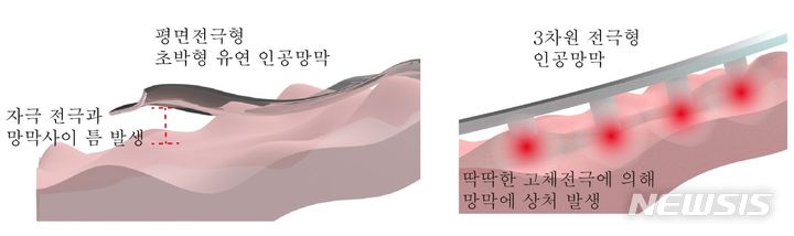 [서울=뉴시스]실명 환자들의 시력을 회복시킬 수 있는 안전성 높은 소프트 인공망막이 개발됐다. (이미지= 세브란스병원 제공) 2024.01.19. photo@newsis.com. 