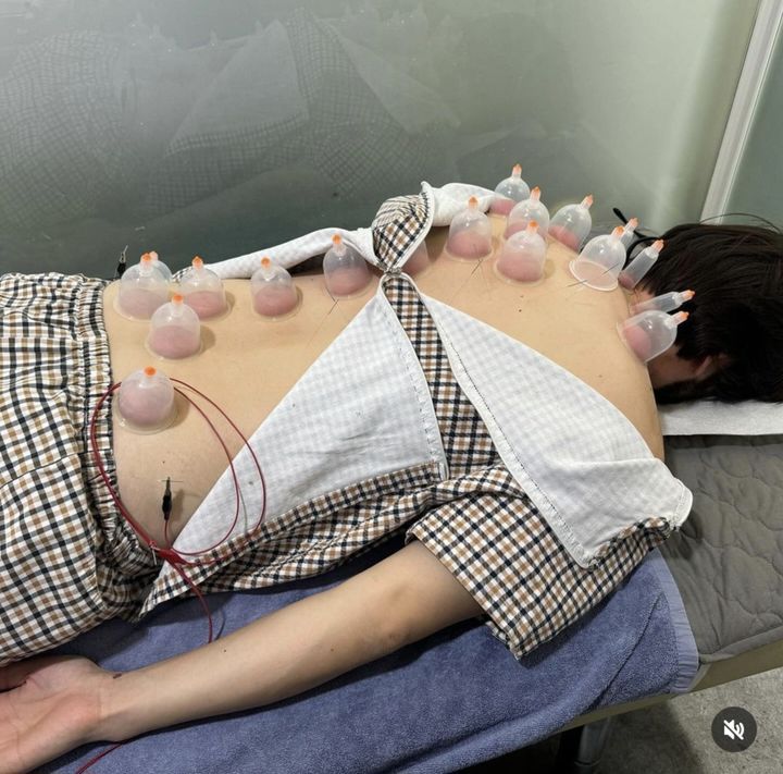 [서울=뉴시스] 노홍철이 부항 치료를 받고 있는 모습. (사진=노홍철 인스타그램 캡처) 2024.02.07. photo@newsis.com *재판매 및 DB 금지