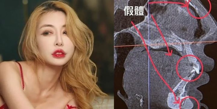 [서울=뉴시스]성형수술을 19번 한 30대 대만 여성이 얼굴 안의 나사 때문에 공항 검색대에서 걸렸다는 사연이 화제가 되고 있다.(사진=인스타그램 캡처) *재판매 및 DB 금지