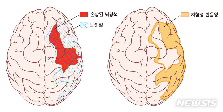 [서울=뉴시스]뇌경색은 뇌혈관이 막히면서 수 시간 내 뇌세포의 괴사가 시작되는데, 뇌경색 치료의 핵심 부위인 ‘허혈성 반음영 부위’의 혈류 재개통을 놓치게 되면 영구적 장애나 사망에도 이를 수 있다. (사진= 강동경희대병원 제공) 2024.05.22. photo@newsis.com. 