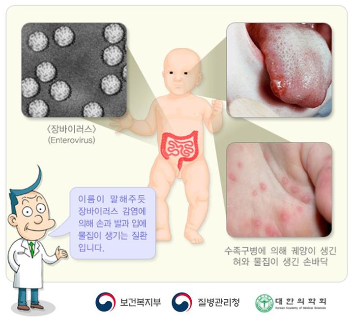 [세종=뉴시스] 수족구병(사진=질병관리청) *재판매 및 DB 금지