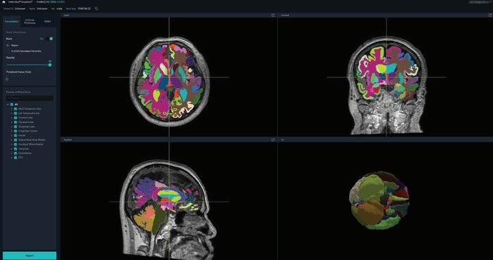 [서울=뉴시스] 4일 의료 인공지능(AI) 기업 뷰노는 AI 기반 뇌 정량화 의료기기 뷰노메드 딥브레인 관련 핵심 기술인 '뇌 피질 영역의 두께를 분석하는 방법'에 대한 특허가 미국에서 등록이 결정됐다고 밝혔다. (사진=뷰노 제공) 2024.06.04. photo@newsis.com *재판매 및 DB 금지