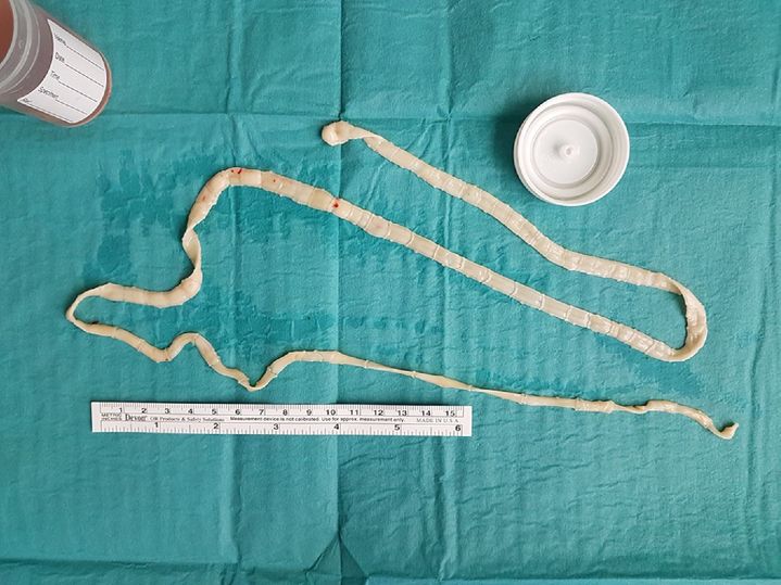 [서울=뉴시스] 싱가포르에서 2년간 가사도우미로 근무한 한 30대 필리핀 여성의 장에서 50cm가 넘는 길이의 기생충이 발견됐다. (사진= 국제외과학회지 사례보고서) *재판매 및 DB 금지