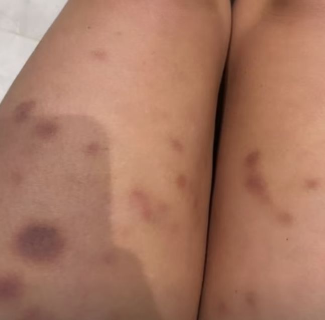 [서울=뉴시스] 벌레에 물려 긁었는데 멍이 든 것을 보고 희귀 자가면역질환을 발견한 방송인 로라 해밀턴(42)의 사연이 알려졌다. (사진= 데일리메일 캡처) *재판매 및 DB 금지