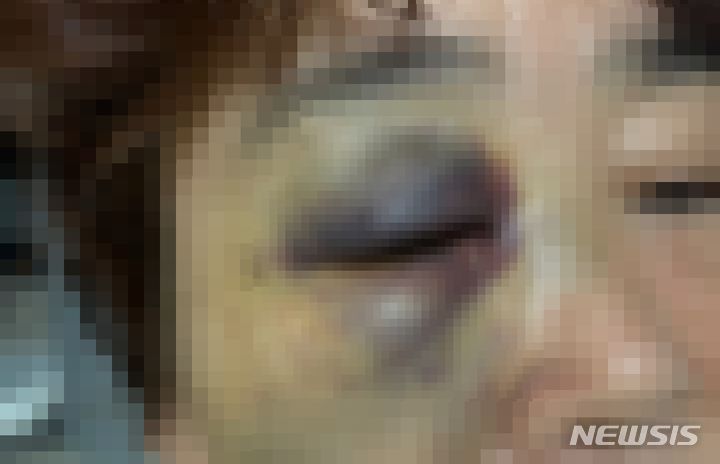 [인천=뉴시스] 요양보호사에게 폭행 당한 여성 지적장애 환자. (사진=피해자 측 제공) 2025.04.17. photo@newsis.com *재판매 및 DB 금지