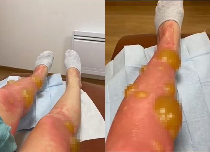 [서울=뉴시스] 프랑스 유명 관광지에 다녀온 뒤 몸 전체에 '테니스 공 크기'의 물집이 생겼다는 충격적인 소식이 전해졌다. (사진=데일리메일) *재판매 및 DB 금지