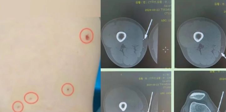 [서울=뉴시스] 중국의 한 남성이 마블 영화의 대표적인 캐릭터 '아이언맨'을 따라하려다 병원으로 이송돼 응급 처치를 받았다는 웃지 못할 사연이 전해졌다. (사진=weibo) *재판매 및 DB 금지