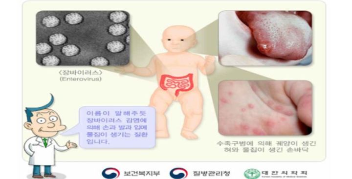 [서울=뉴시스] 여름 휴가철을 앞두고 수족구병이 유행해 영유아 자녀를 둔 부모들에게 비상이 걸렸다. 수족구병은 영유아(0~6세) 감염률이 90%에 이르는 것으로 알려졌다(사진= 질병관리청 제공) *재판매 및 DB 금지