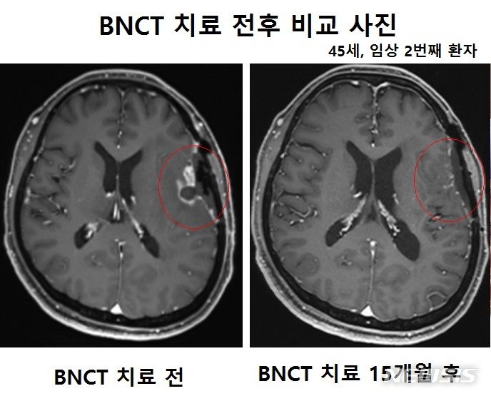 [서울=뉴시스]붕소중성자포획치료기(A-BNCT) 치료 전후 사진. A-BNCT는 붕소 화합물을 체내 주입한 후 붕소를 섭취한 종양 세포에 중성자를 조사해 핵반응을 일으켜 종양 세포만 사멸시키는 치료법이다.(사진= 가천대길병원 제공) 2024.07.24. photo@newsis.com.