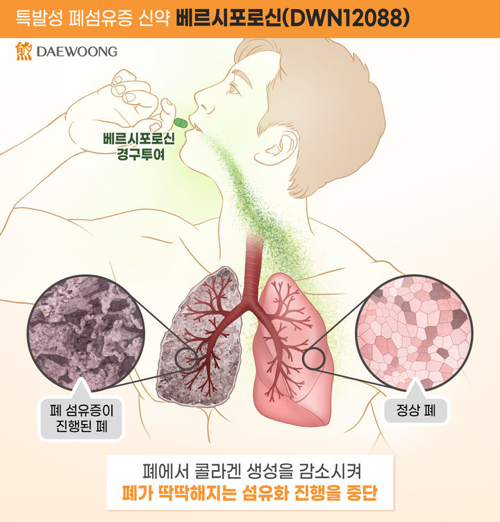 [서울=뉴시스] 대웅제약 베르시포로신(DWN12088) 작용 기전. (사진=대웅제약 제공) 2024.07.29. photo@newsis.com *재판매 및 DB 금지