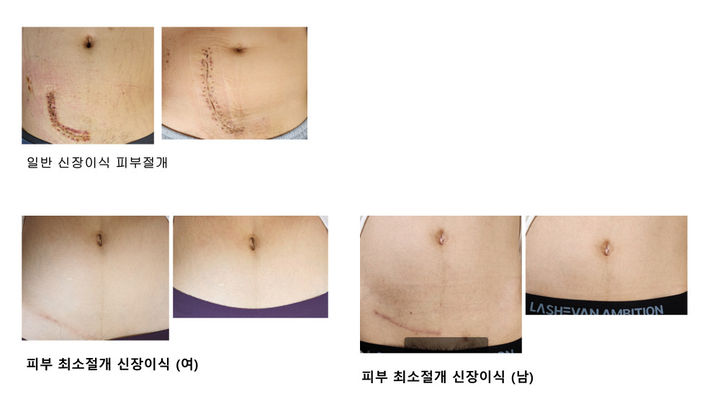 [서울=뉴시스] 30일 대한민국 최초 신장이식 수술을 성공적으로 시행한 가톨릭대학교 서울성모병원 장기이식센터가 국내 처음으로 ‘피부 최소절개 신장이식 수술 100례’를 달성했다. (사진=서울성모병원제공) 2024.07.30. photo@newsis.com *재판매 및 DB 금지