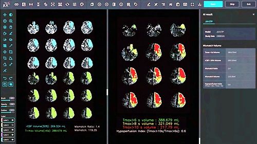 뇌 관류영상 분석 AI 솔루션 'JLK-CTP' (사진=제이엘케이 제공) *재판매 및 DB 금지