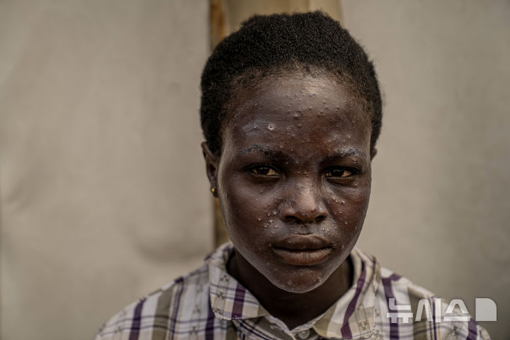 [무니기=AP/뉴시스] 19일(현지시각) 콩고민주공화국(민주콩고) 동부 무니기의 한 진료소에서 엠폭스에 걸린 환자가 치료를 받기 위해 대기하고 있다. 민주콩고 보건부 장관은 다음 주에 미국에서 엠폭스 대응을 위한 첫 번째 백신이 들어올 것이라고 밝혔다. 2024.08.20.