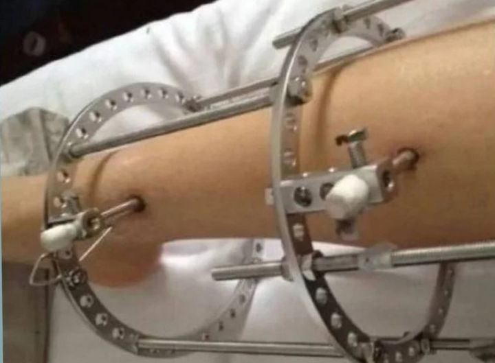 [서울=뉴시스] 중국에서 키를 늘리는 수술을 받은 후 부작용을 겪는 사람들이 늘어나고 있다. (사진= 웨이보 갈무리) *재판매 및 DB 금지