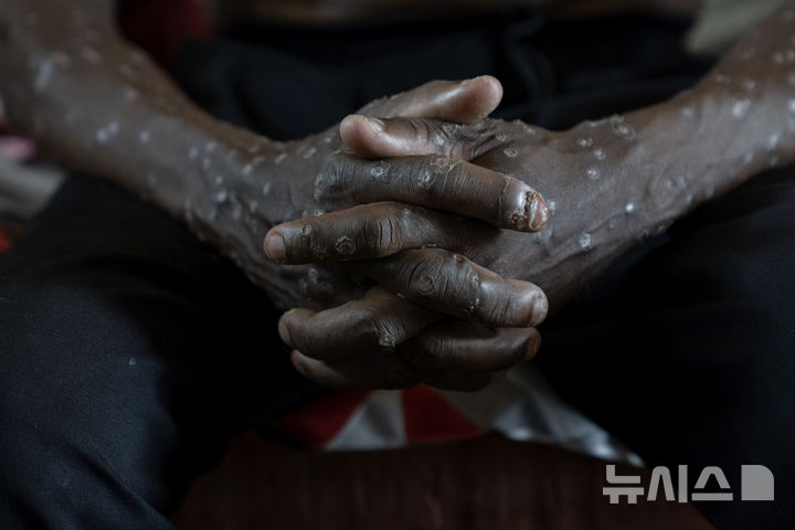 [부카부=AP/뉴시스] 4일(현지시각) 콩고민주공화국 남키부주 가미투가 종합병원에서 엠폭스(MPOX)를 앓고 있는 남성이 치료를 기다리고 있다. 아프리카 질병통제예방센터(CDC) 장 카세야 사무총장은 9만9천회 이상 접종이 가능한 첫 백신이 5일 유럽연합(EU)으로부터 도착한다고 밝혔다. 2024.09.05.