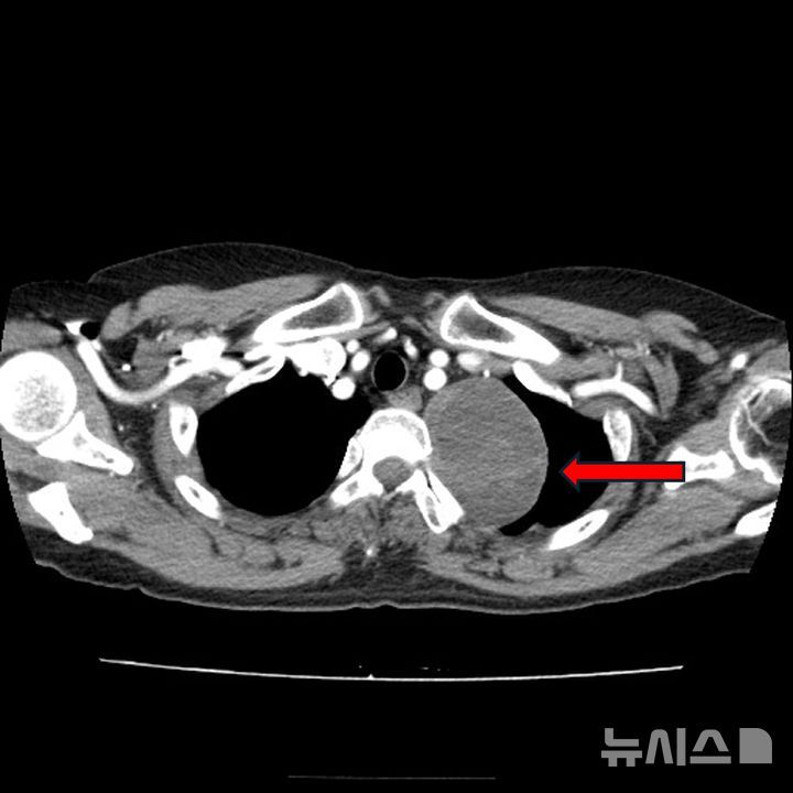 [서울=뉴시스]가슴뼈와 척추 사이 빈 공간에 발생하는 '종격동 종양'은 종양이 압박하는 기관에 따라 기침, 호흡곤란, 목의 이물감, 늑간 신경통 등 증상이 다르게 나타난다. 종격동 종양 환자의 흉부 CT 사진.(사진= 고려대 안산병원 제공) 2024.09.21. photo@newsis.com. 